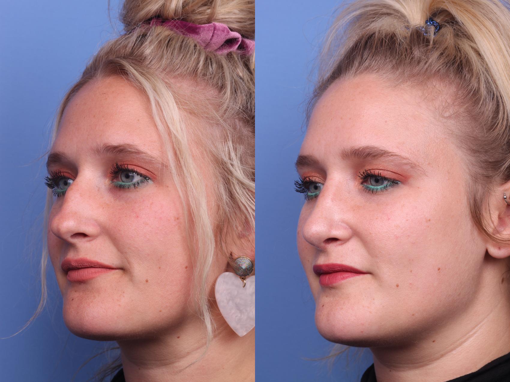 Before & After Rhinoplasty Case 205 View #2 View in Scottsdale, AZ
