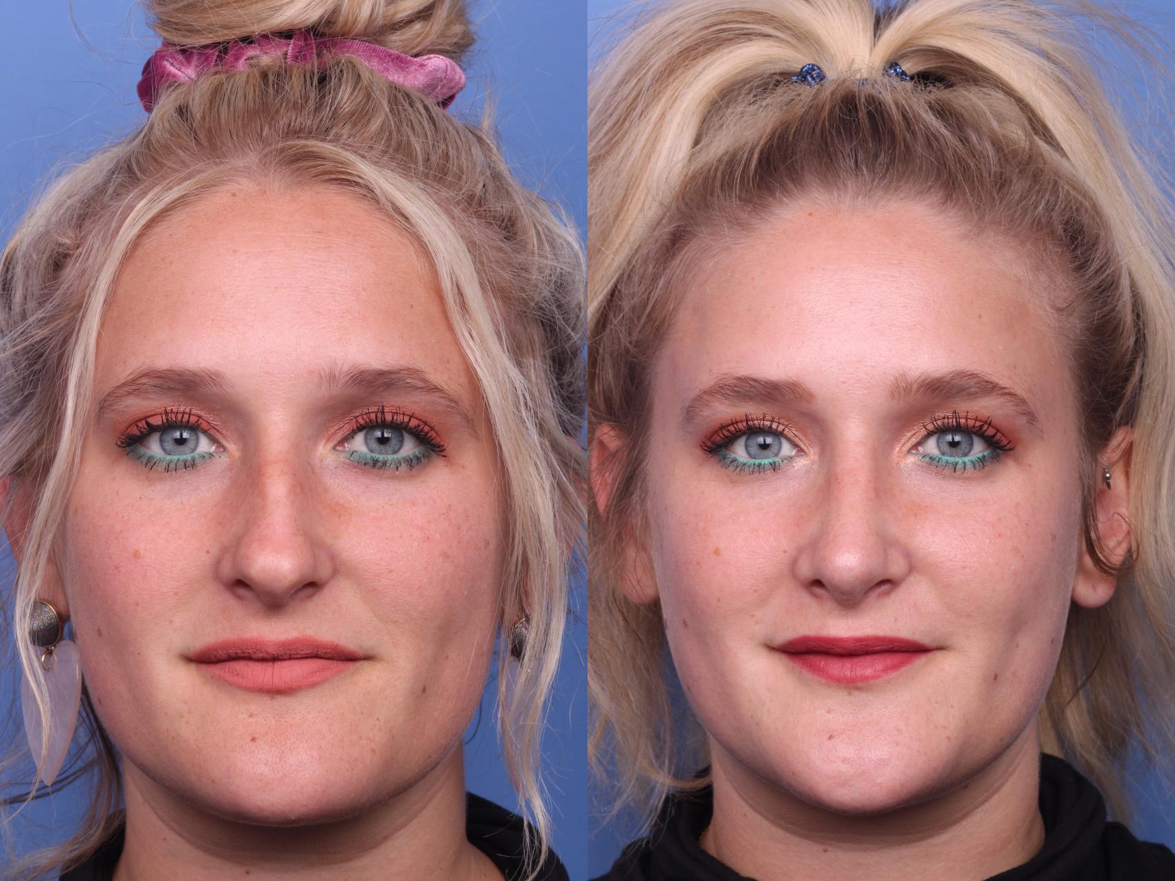 Before & After Rhinoplasty Case 205 View #3 View in Scottsdale, AZ