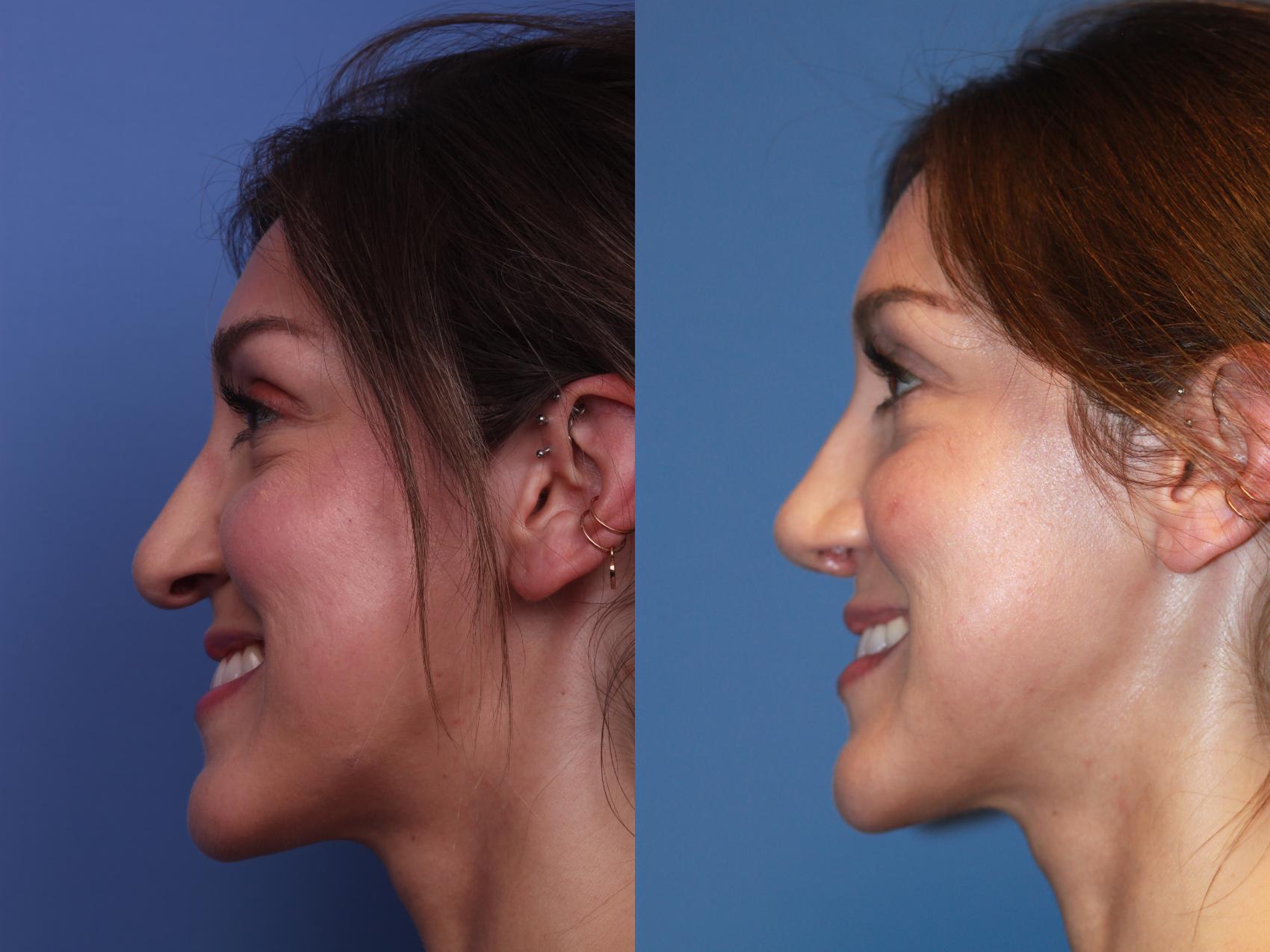 Before & After Rhinoplasty Case 207 View #2 View in Scottsdale, AZ