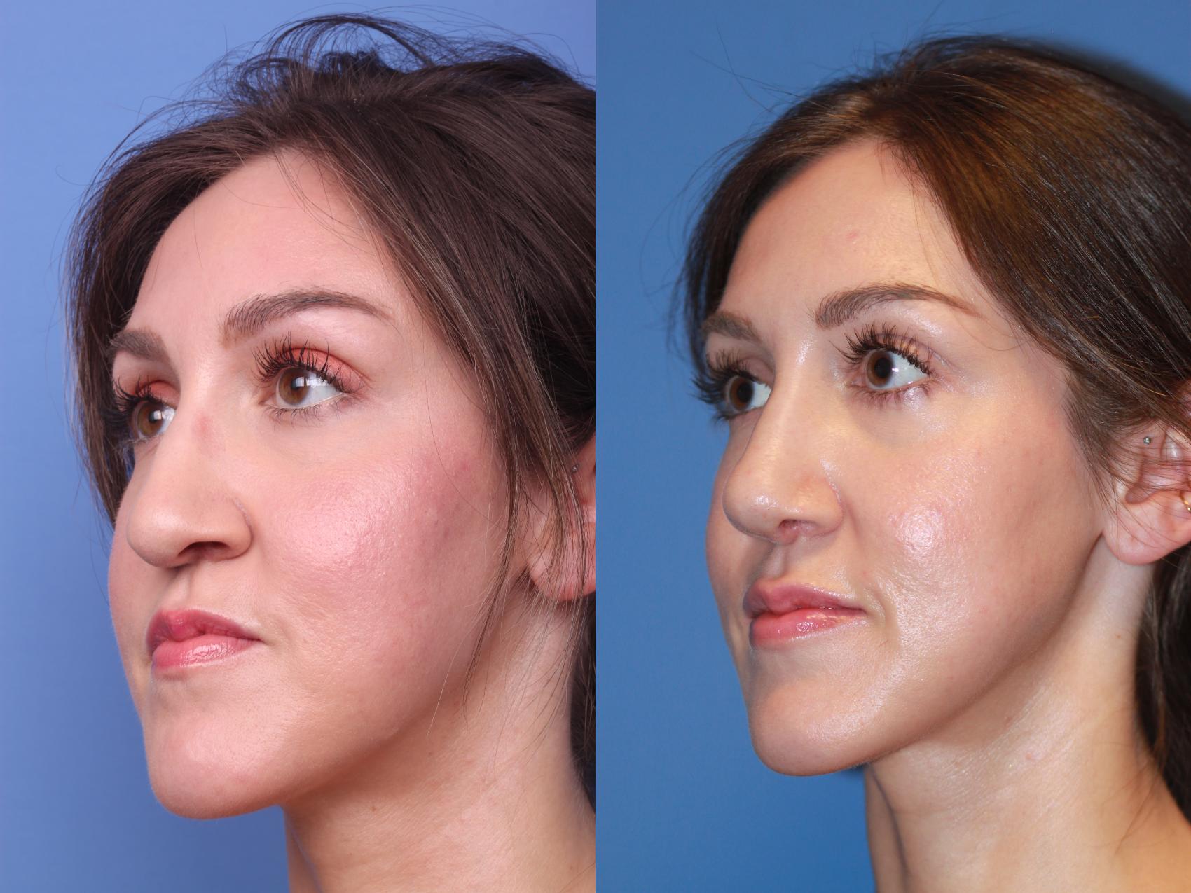 Before & After Rhinoplasty Case 207 View #3 View in Scottsdale, AZ