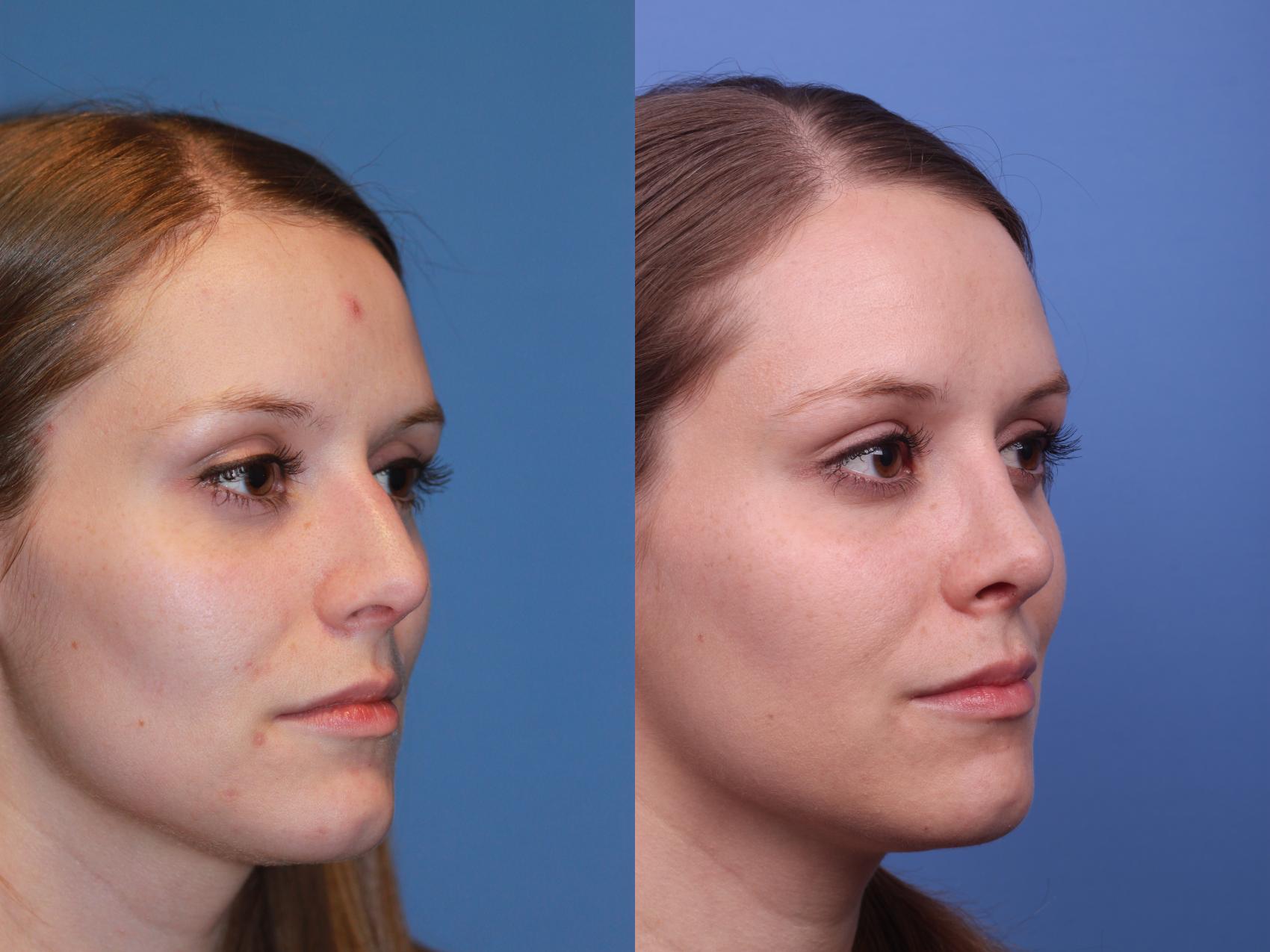 Before & After Rhinoplasty Case 209 View #2 View in Scottsdale, AZ