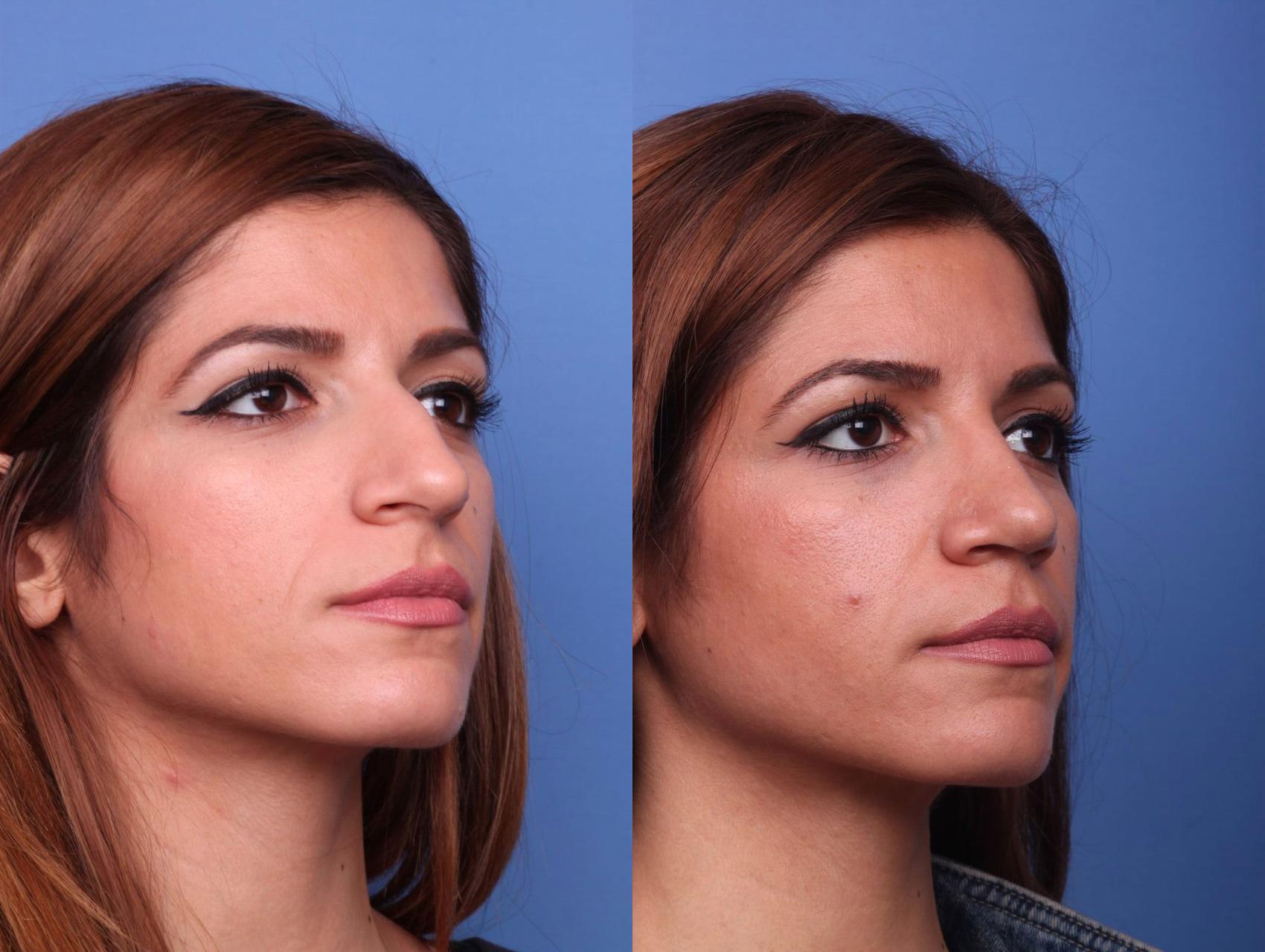 Before & After Rhinoplasty Case 21 View #2 View in Scottsdale, AZ