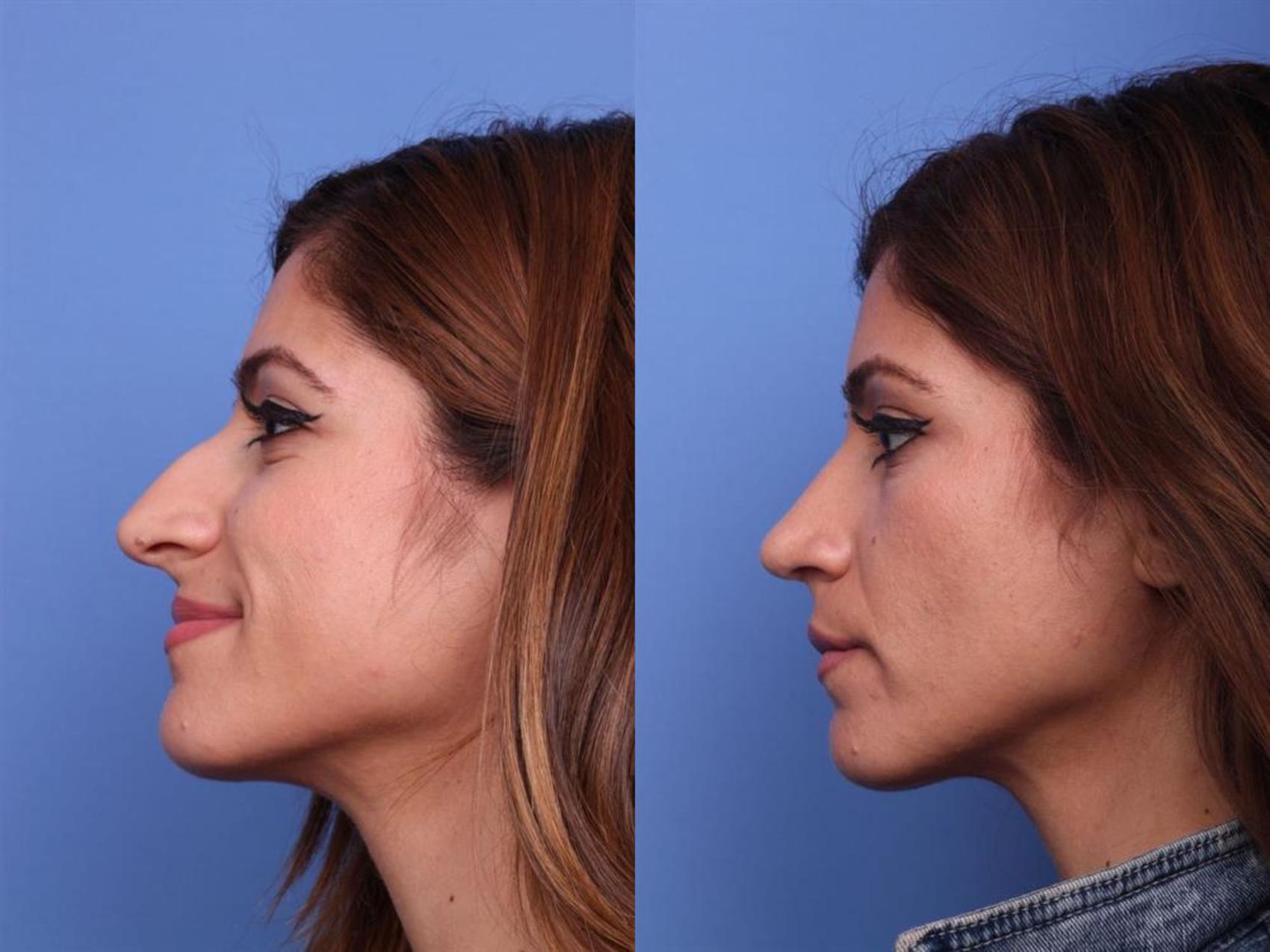 Before & After Rhinoplasty Case 21 View #3 View in Scottsdale, AZ