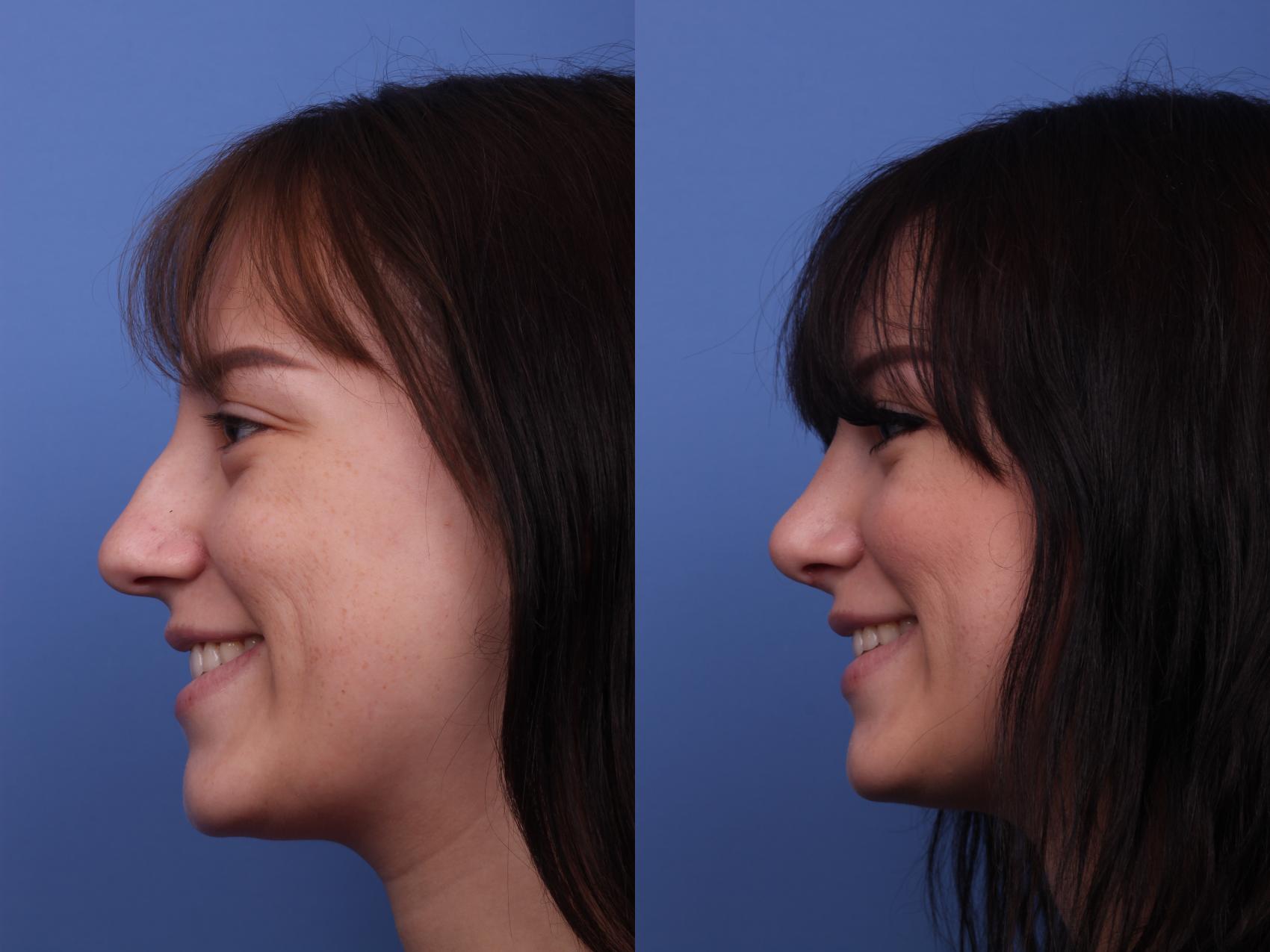 Before & After Rhinoplasty Case 212 View #2 View in Scottsdale, AZ