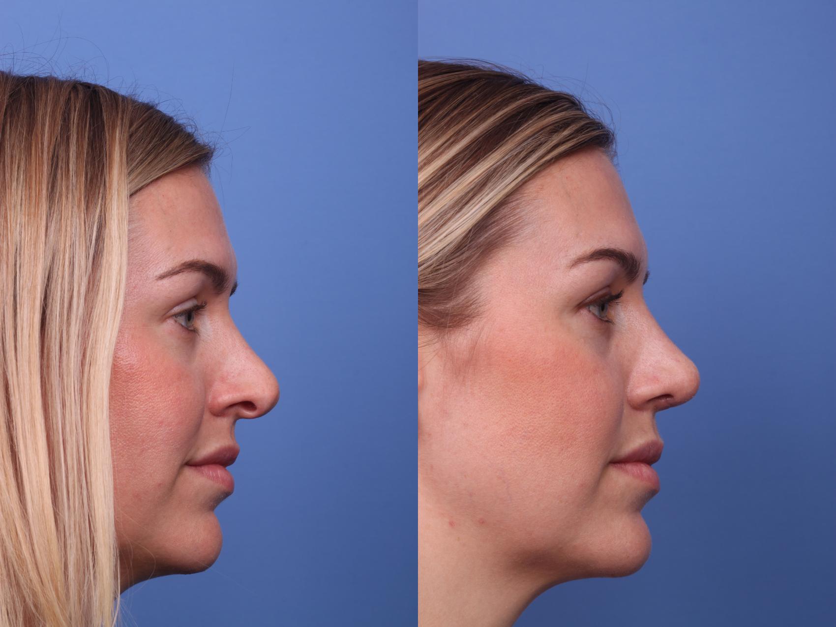 Before & After Rhinoplasty Case 216 View #2 View in Scottsdale, AZ