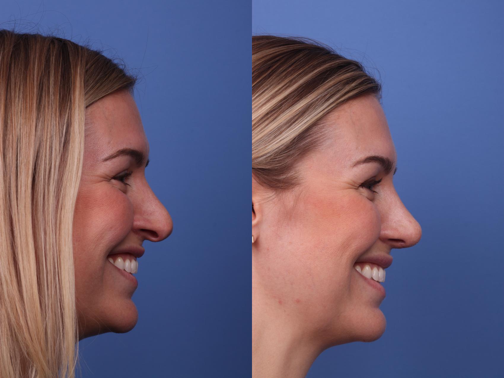 Before & After Rhinoplasty Case 216 View #3 View in Scottsdale, AZ