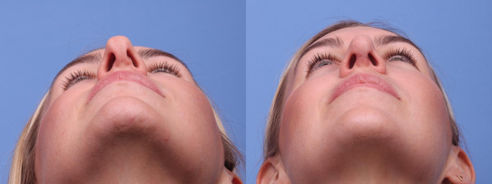 Before & After Rhinoplasty Case 216 View #4 View in Scottsdale, AZ