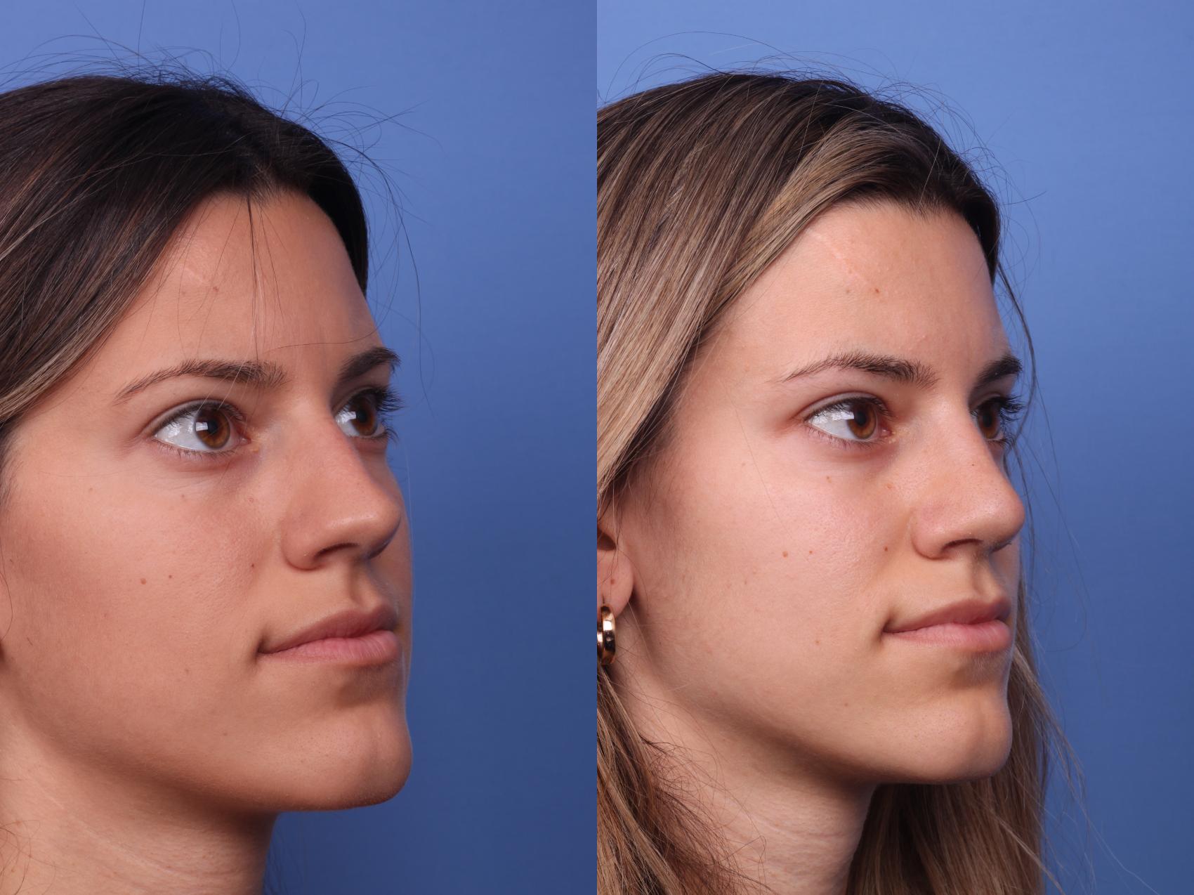 Before & After Rhinoplasty Case 217 View #2 View in Scottsdale, AZ