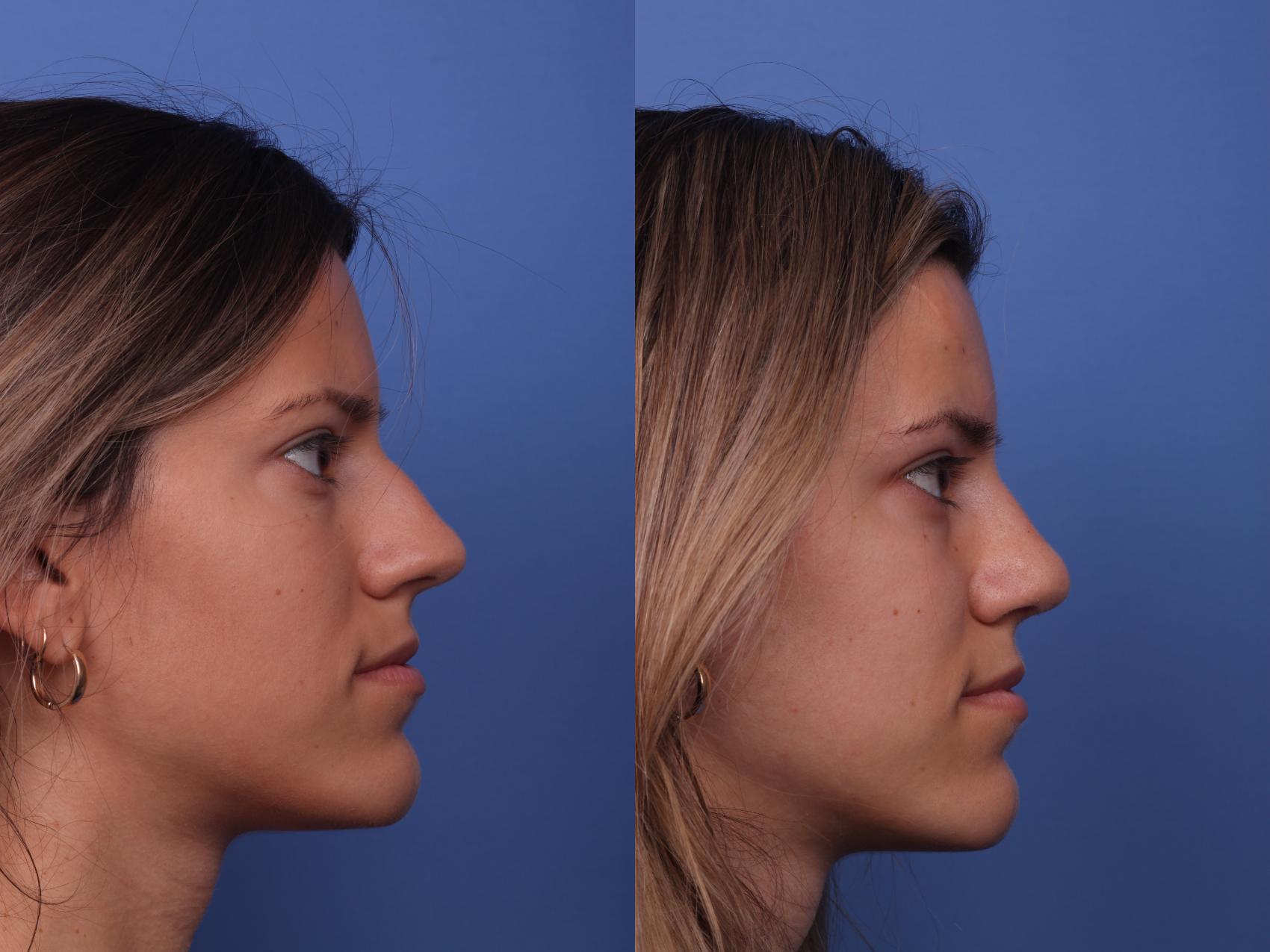 Before & After Rhinoplasty Case 217 View #3 View in Scottsdale, AZ