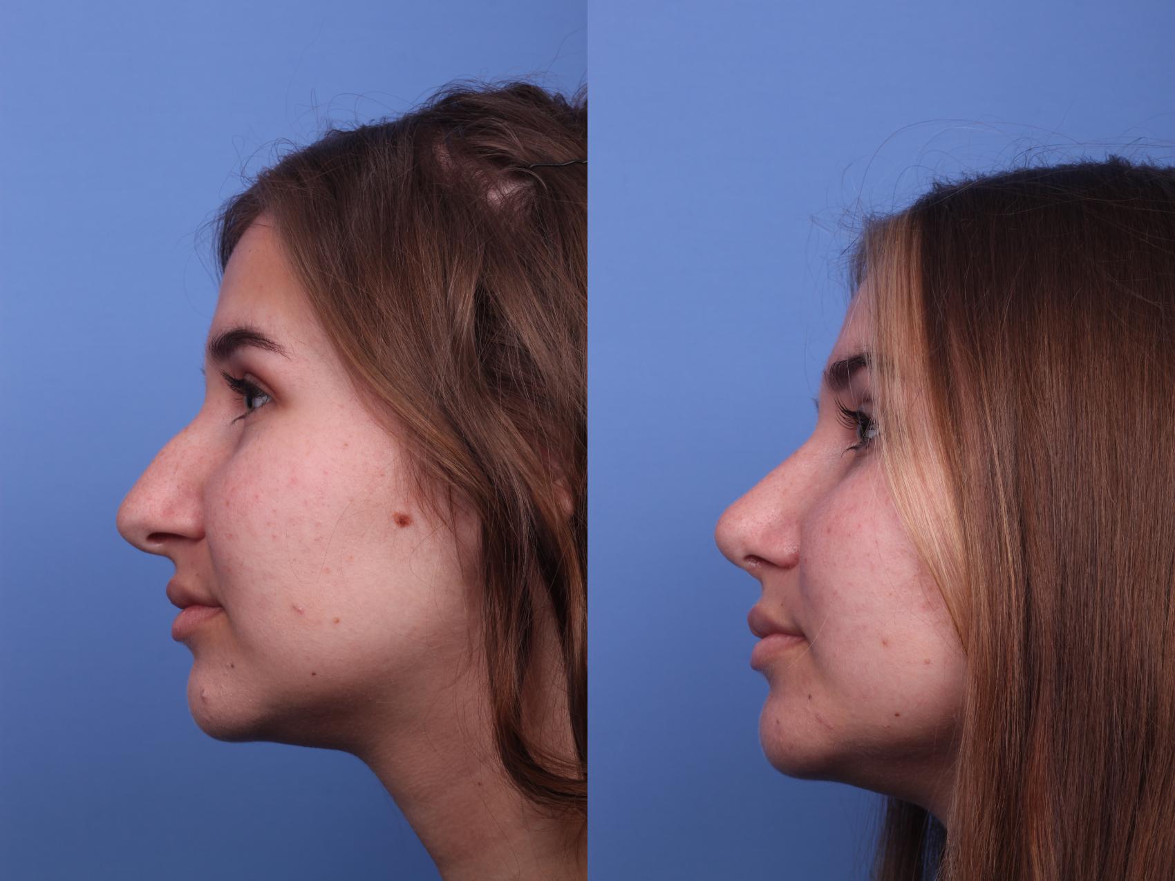 Before & After Rhinoplasty Case 219 View #2 View in Scottsdale, AZ