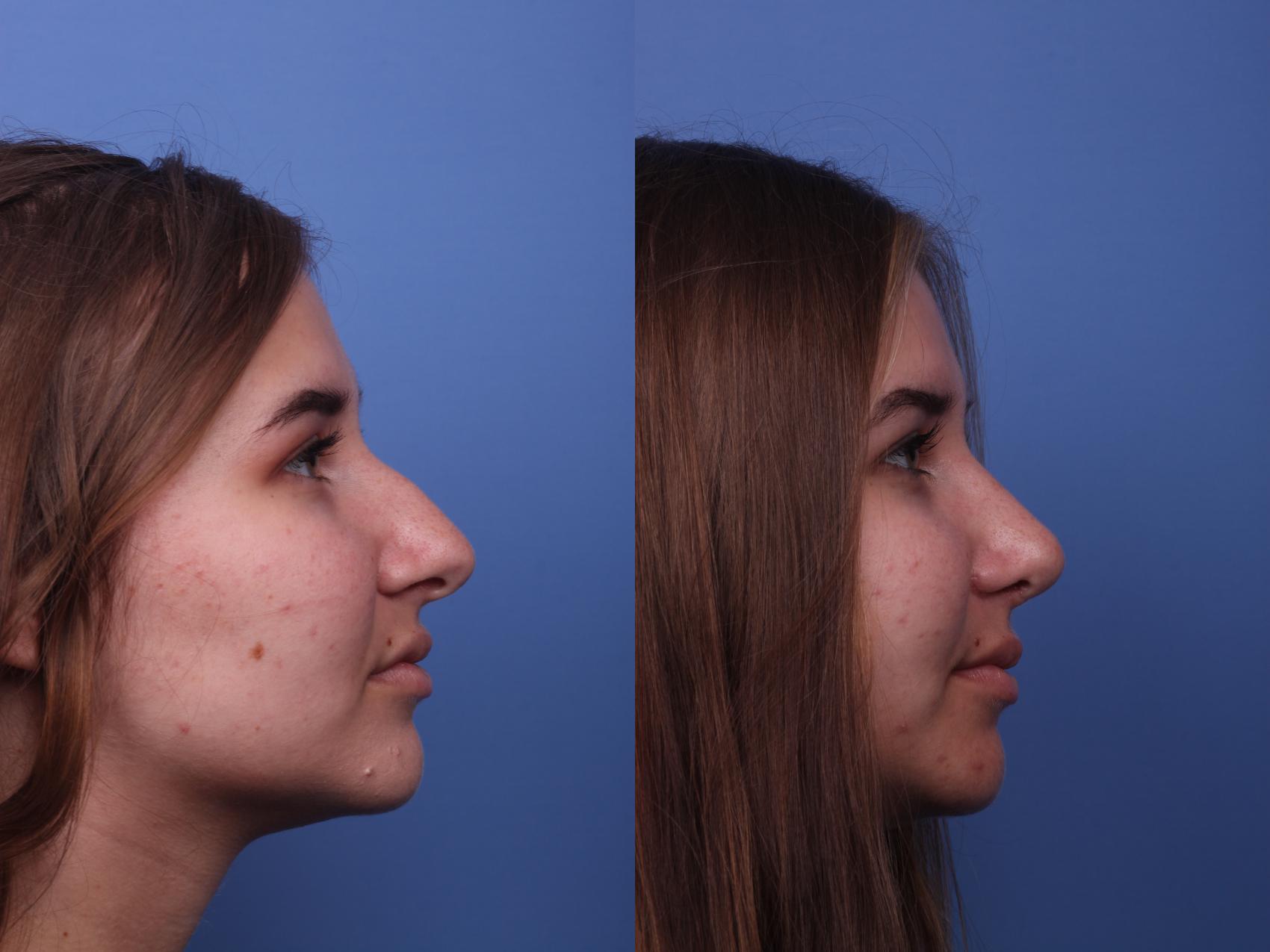 Before & After Rhinoplasty Case 219 View #3 View in Scottsdale, AZ