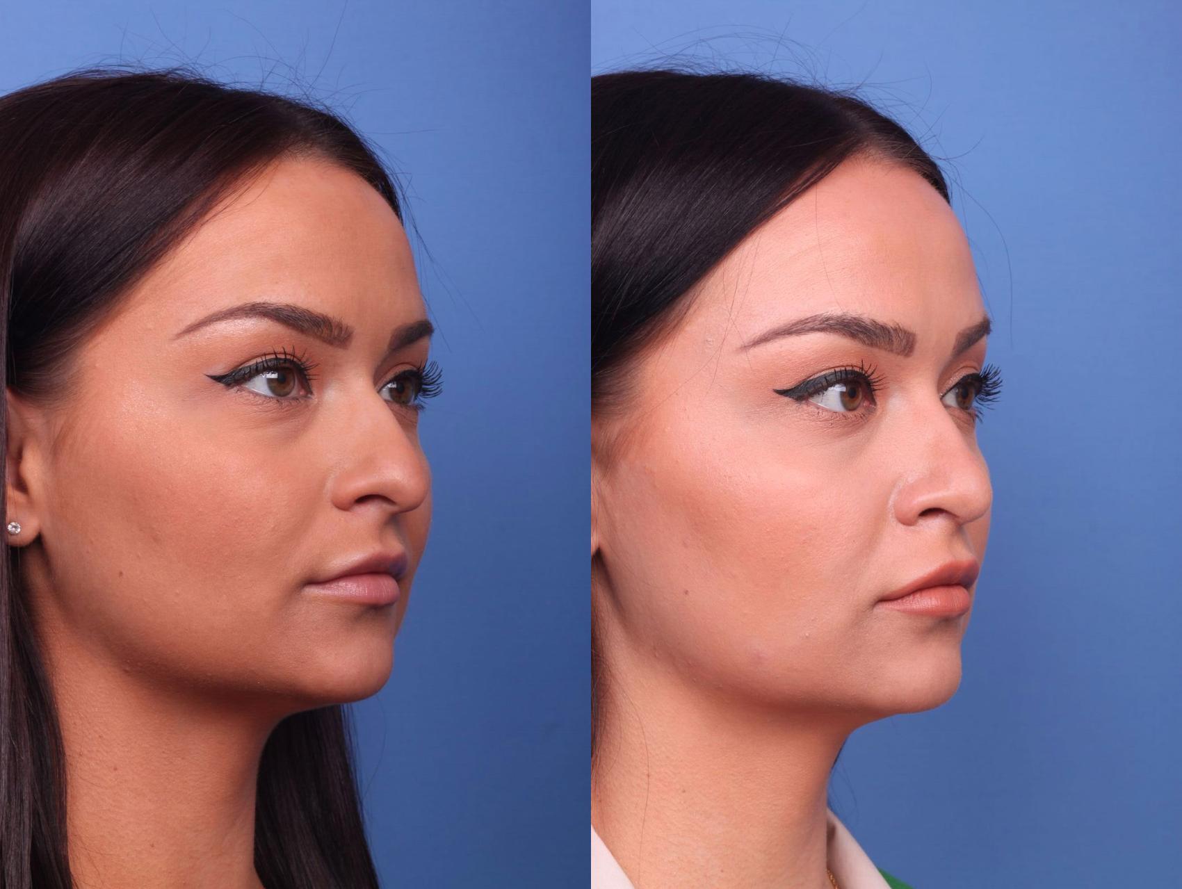 Before & After Rhinoplasty Case 22 View #2 View in Scottsdale, AZ