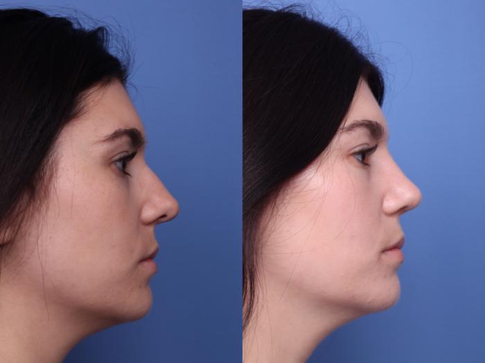 Rhinoplasty Before & After Photo | Scottsdale & Phoenix, AZ | Hobgood Facial Plastic Surgery: Todd Hobgood, MD