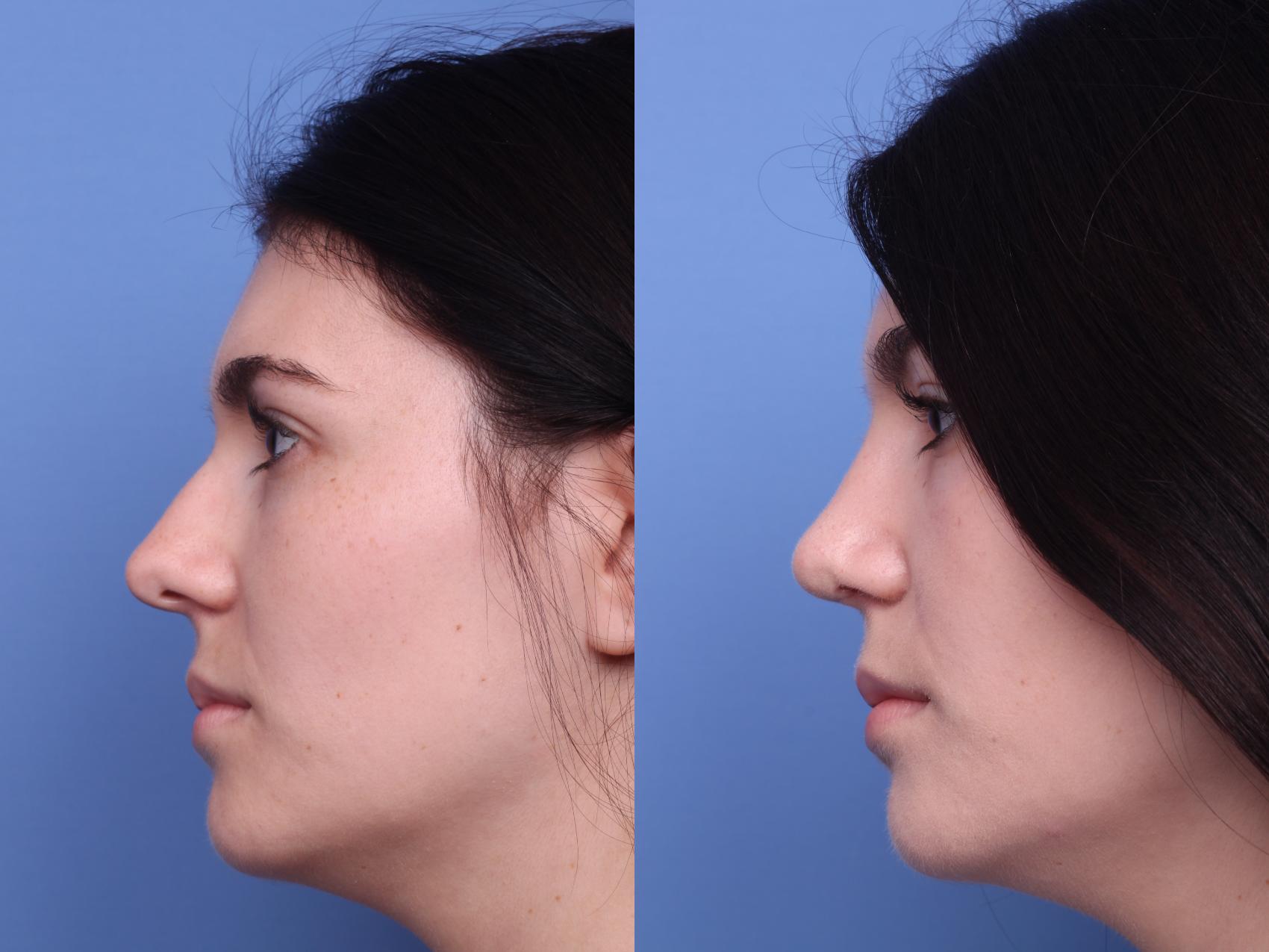 Before & After Rhinoplasty Case 220 View #2 View in Scottsdale, AZ