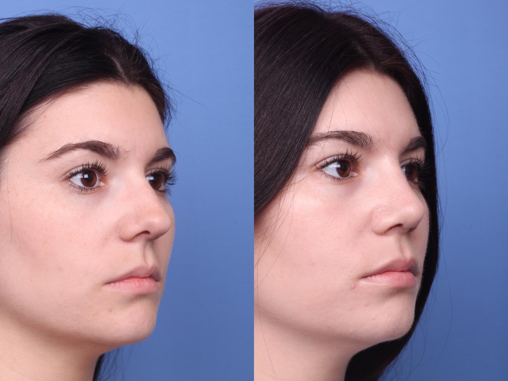 Before & After Rhinoplasty Case 220 View #3 View in Scottsdale, AZ