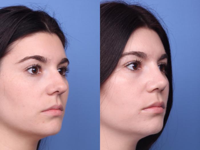 Rhinoplasty Before & After Photo | Scottsdale & Phoenix, AZ | Hobgood Facial Plastic Surgery: Todd Hobgood, MD