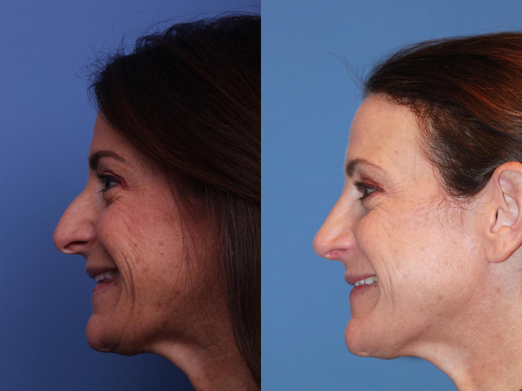 Before & After Rhinoplasty Case 221 View #2 View in Scottsdale, AZ