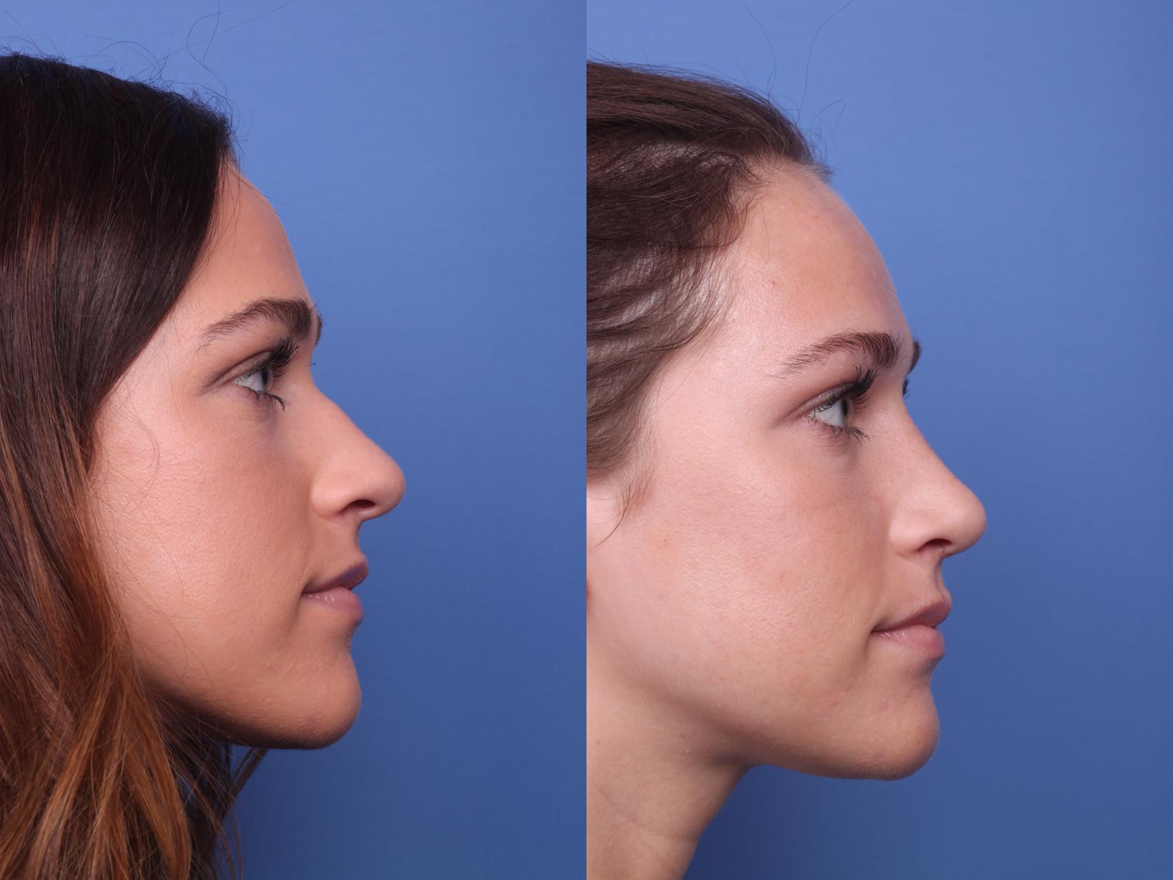 Before & After Rhinoplasty Case 223 View #3 View in Scottsdale, AZ