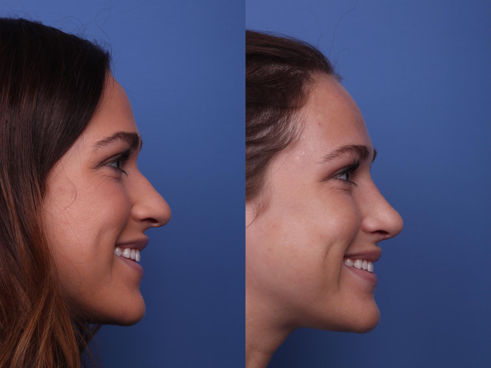 Before & After Rhinoplasty Case 223 View #4 View in Scottsdale, AZ