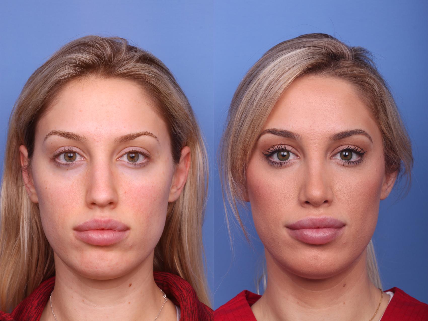 Rhinoplasty (Nose Job) for Scottsdale Phoenix AZ Dr Todd Hobgood. 