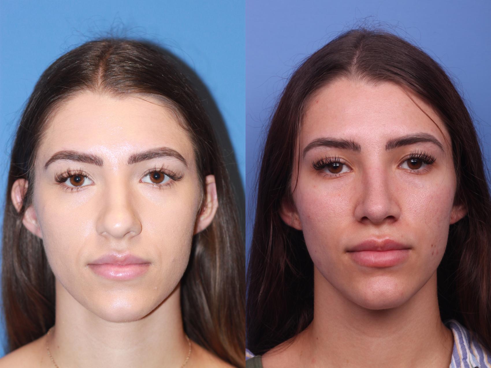 Before & After Rhinoplasty Case 226 View #2 View in Scottsdale, AZ