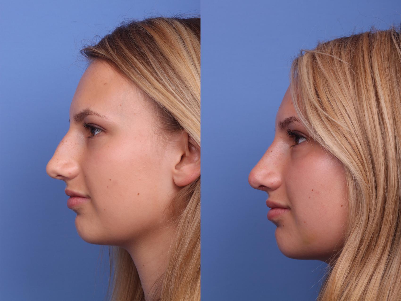 Before & After Rhinoplasty Case 227 View #2 View in Scottsdale, AZ
