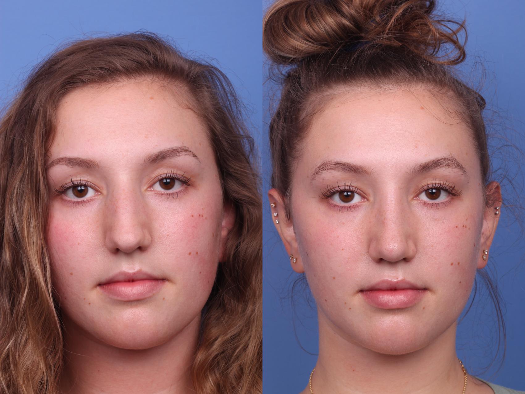 Before & After Rhinoplasty Case 228 View #2 View in Scottsdale, AZ