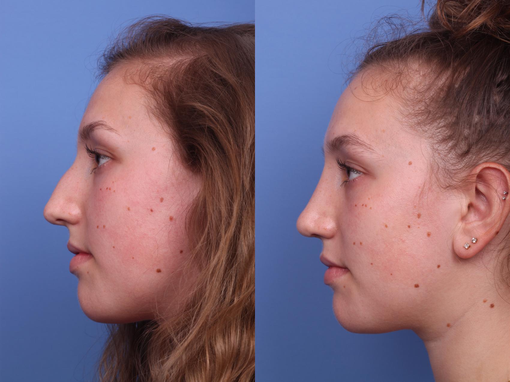 Before & After Rhinoplasty Case 228 View #3 View in Scottsdale, AZ