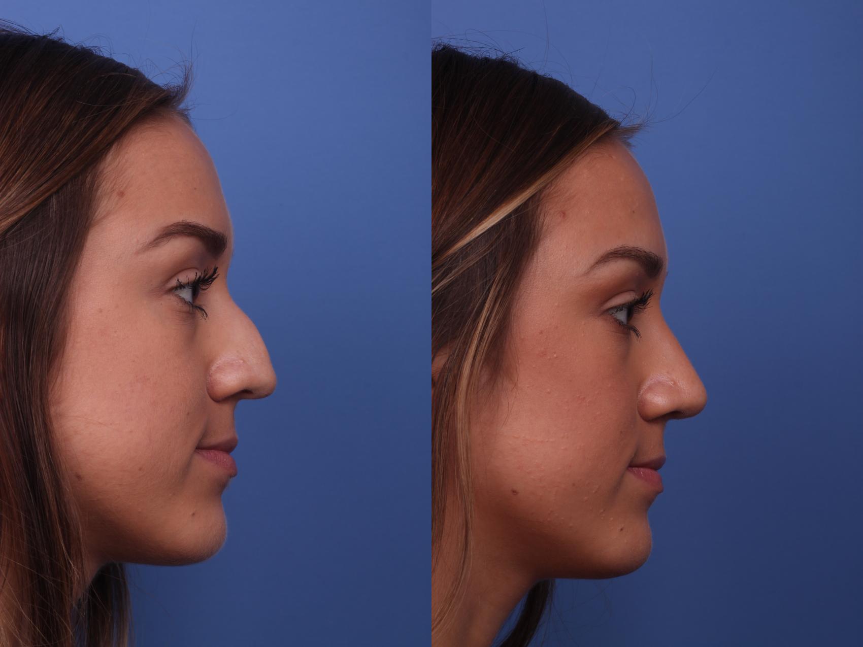 Rhinoplasty Before & After Photo | Scottsdale, AZ | Hobgood Facial Plastic Surgery: Todd Hobgood, MD