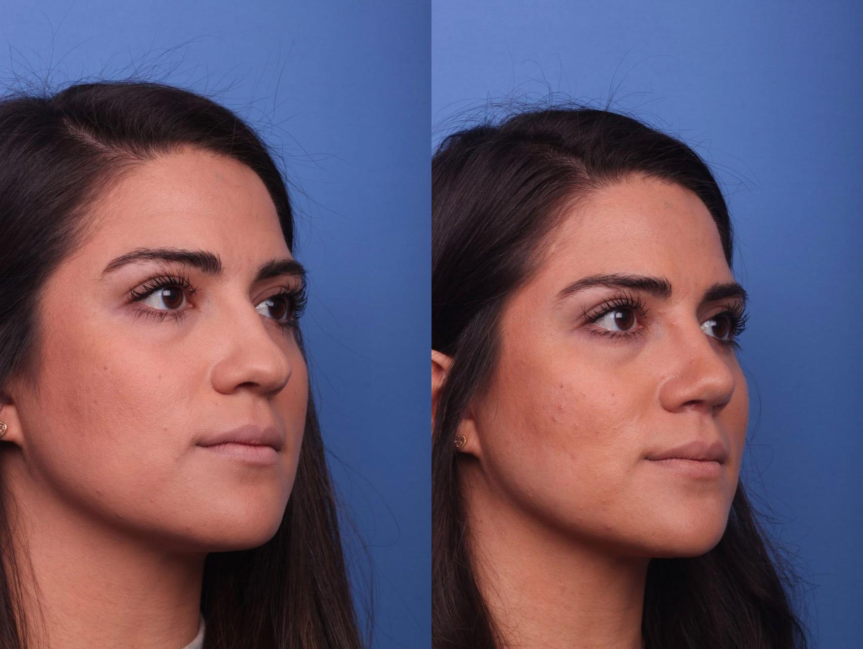 Before & After Rhinoplasty Case 23 View #2 View in Scottsdale, AZ