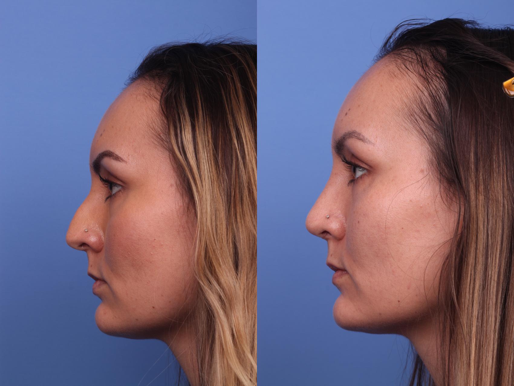 Before & After Rhinoplasty Case 233 View #2 View in Scottsdale, AZ