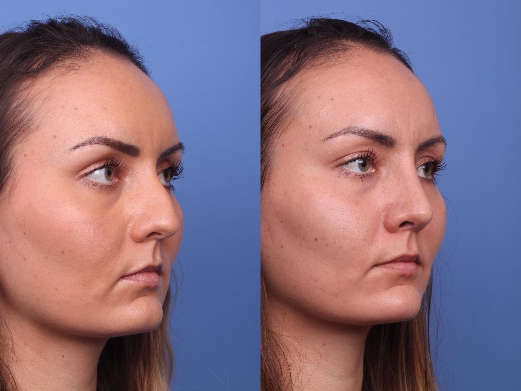 Before & After Rhinoplasty Case 233 View #3 View in Scottsdale, AZ
