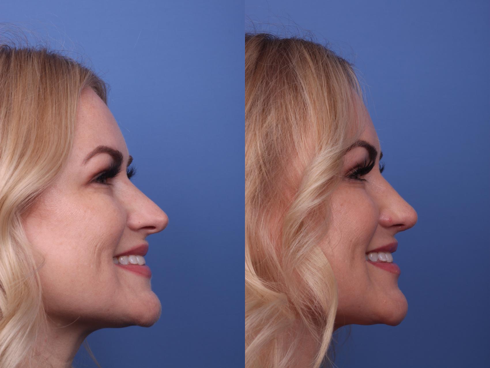 Before & After Rhinoplasty Case 234 View #2 View in Scottsdale, AZ