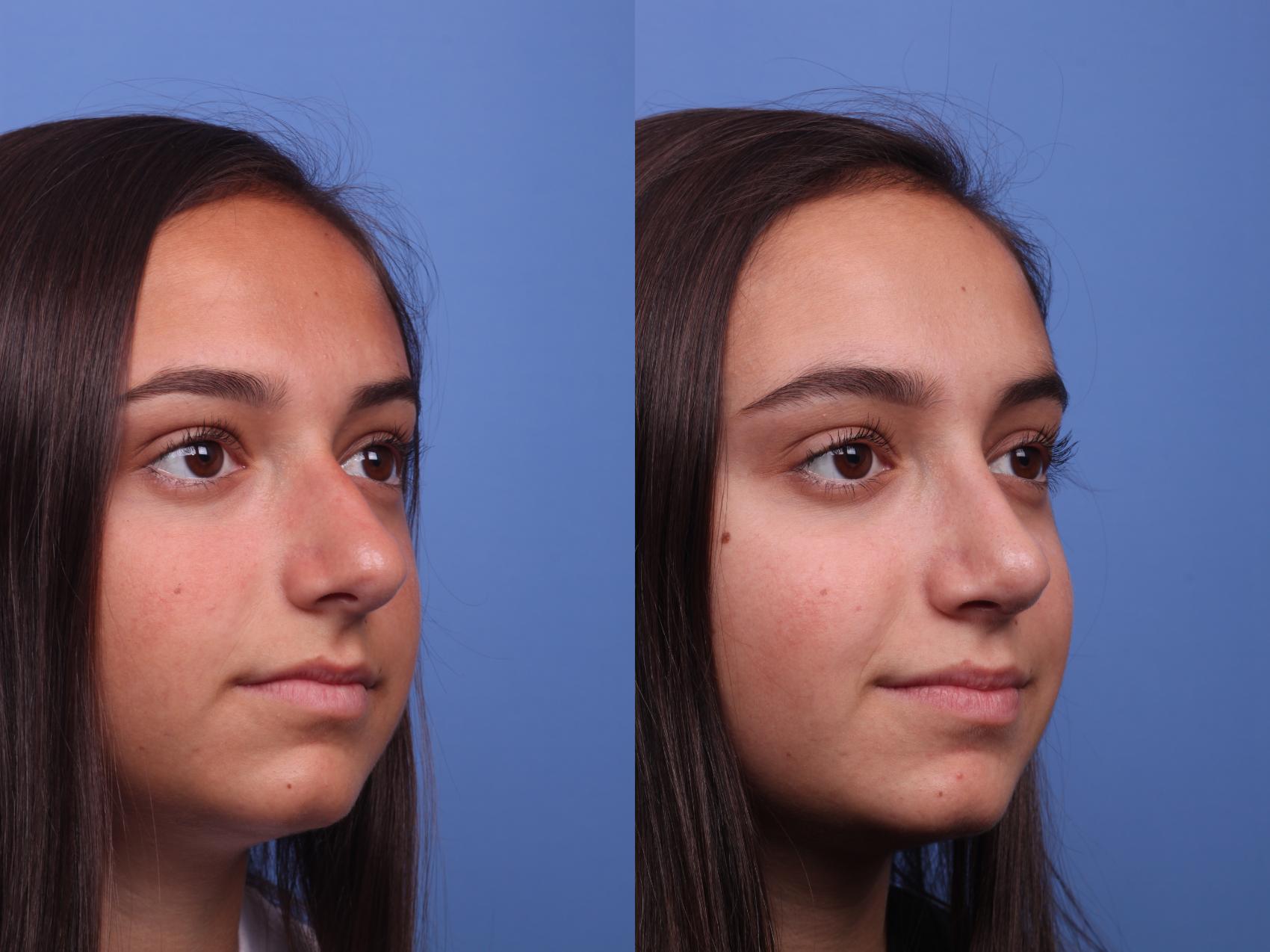 Before & After Rhinoplasty Case 235 View #2 View in Scottsdale, AZ