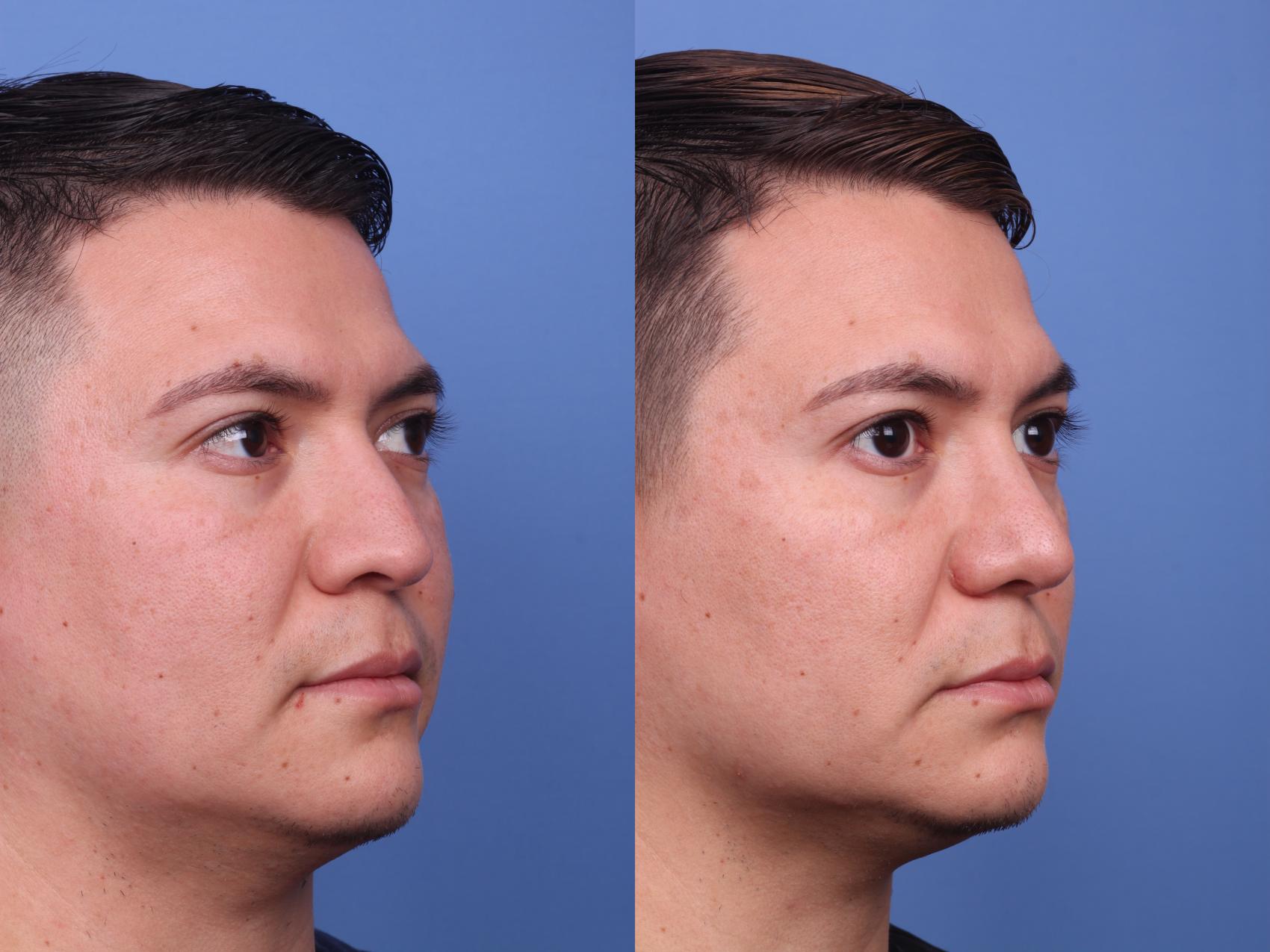 Before & After Ethnic Rhinoplasty Case 237 View #2 View in Scottsdale, AZ