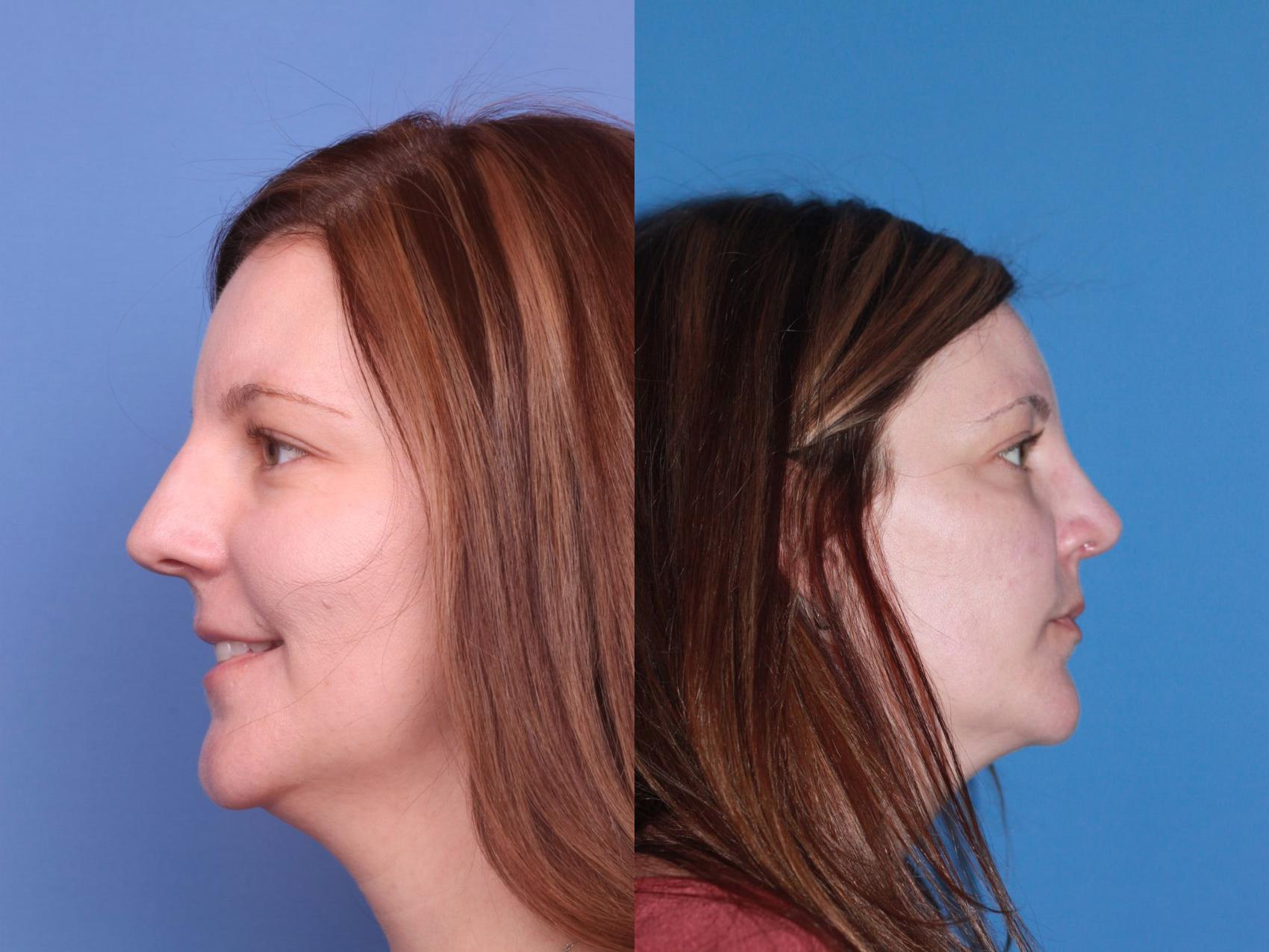 Before & After Rhinoplasty Case 24 View #2 View in Scottsdale, AZ