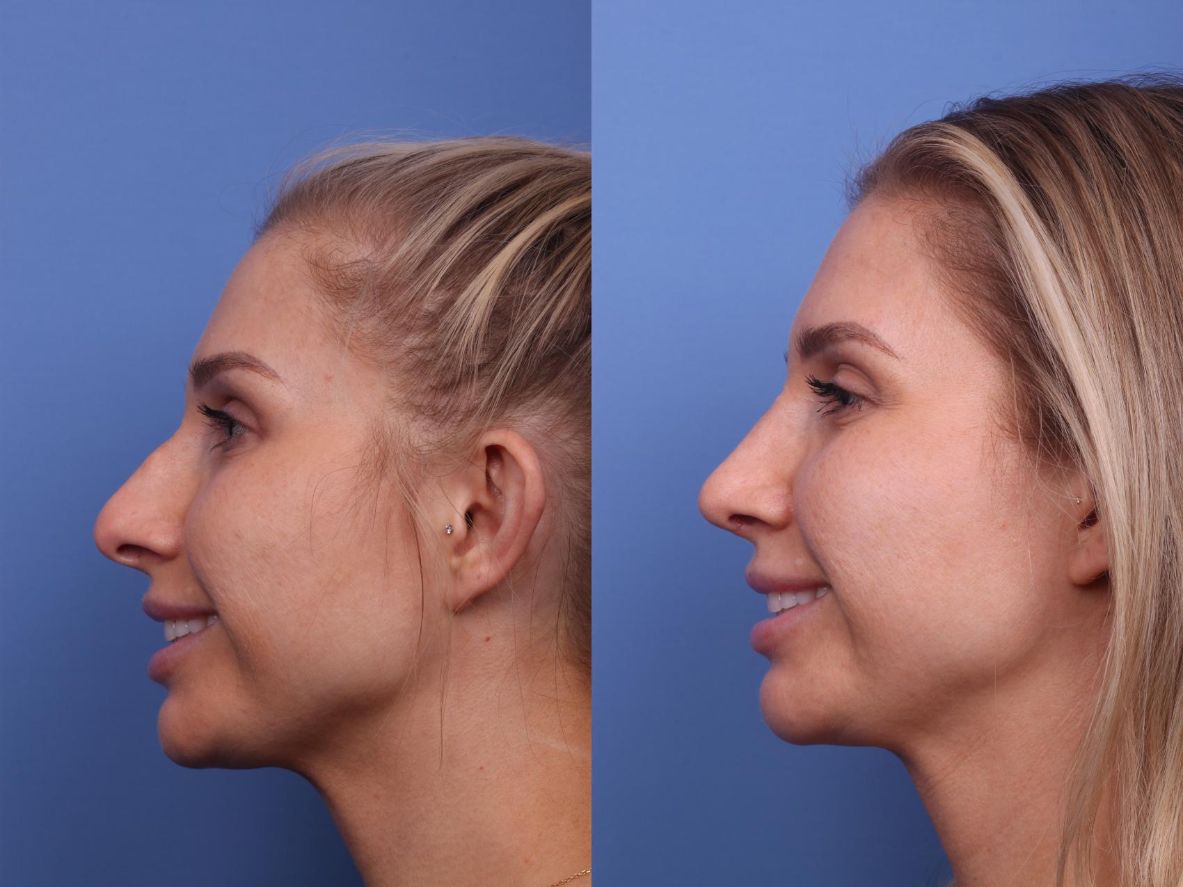 Before & After Rhinoplasty Case 241 View #2 View in Scottsdale, AZ
