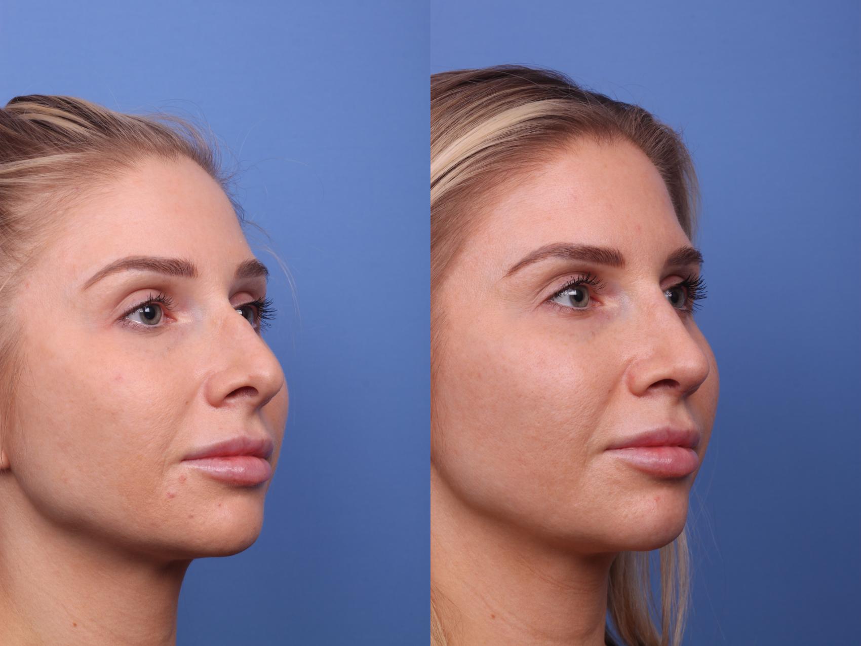 Before & After Rhinoplasty Case 241 View #3 View in Scottsdale, AZ