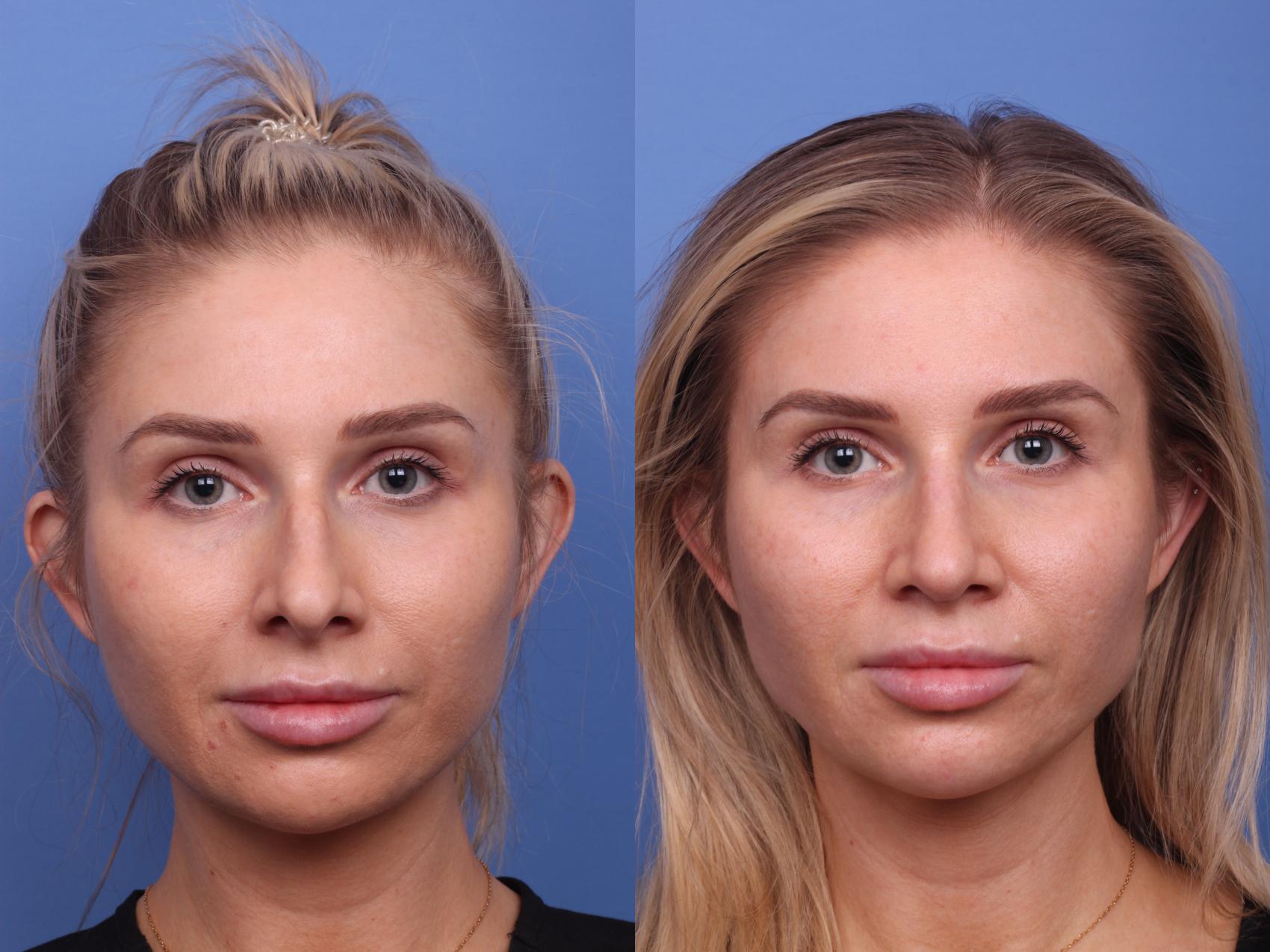 Before & After Rhinoplasty Case 241 View #4 View in Scottsdale, AZ