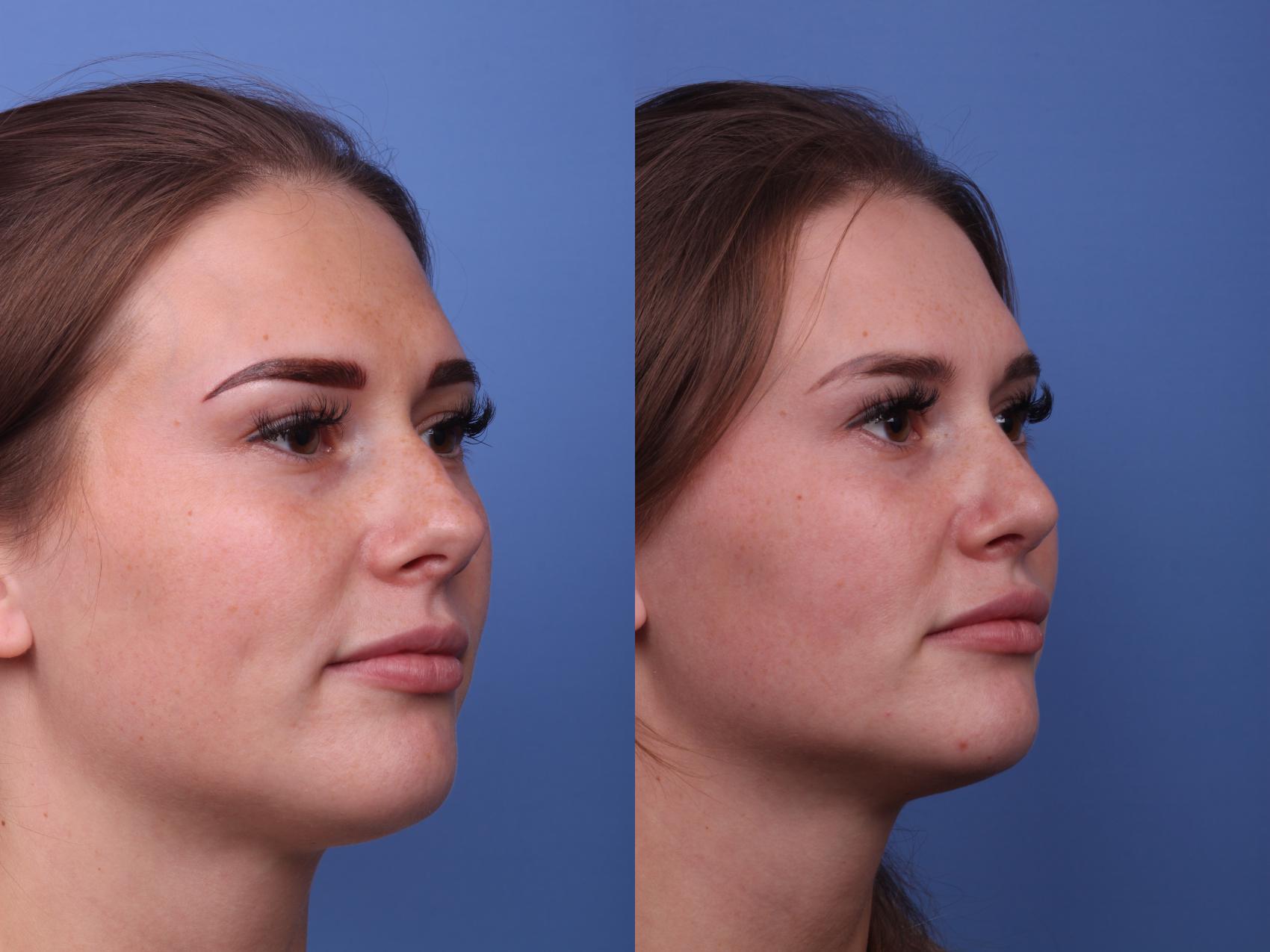 Before & After Rhinoplasty Case 242 View #2 View in Scottsdale, AZ
