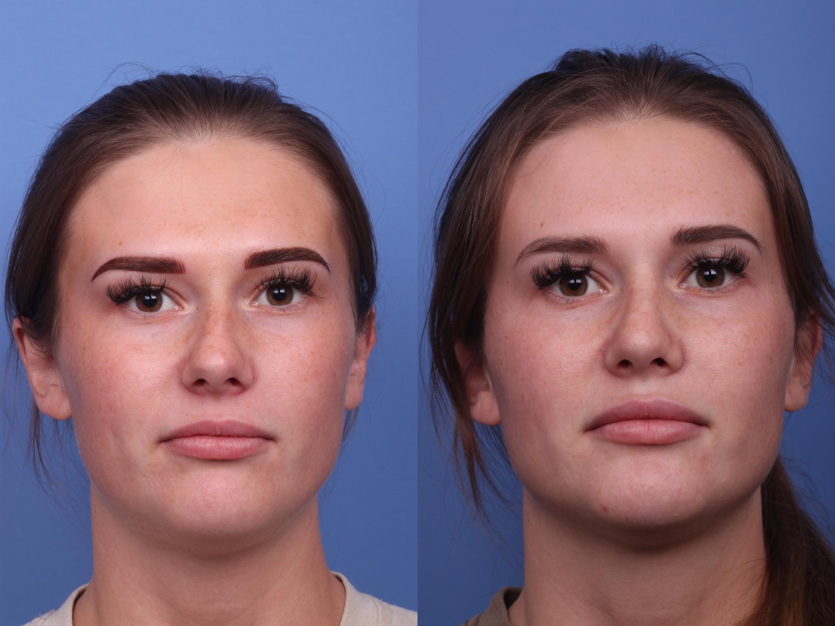 Before & After Rhinoplasty Case 242 View #3 View in Scottsdale, AZ