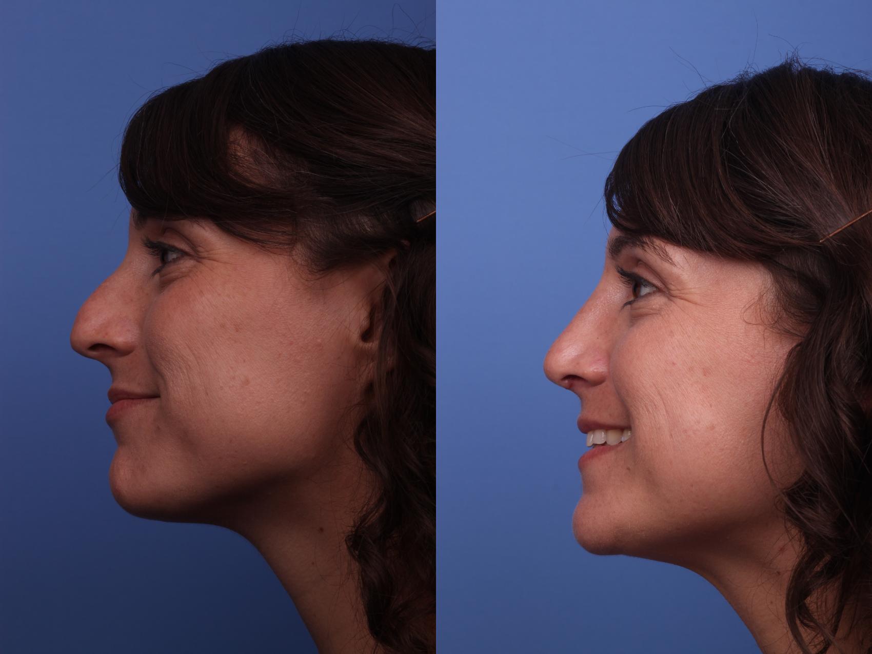 Before & After Rhinoplasty Case 243 View #2 View in Scottsdale, AZ