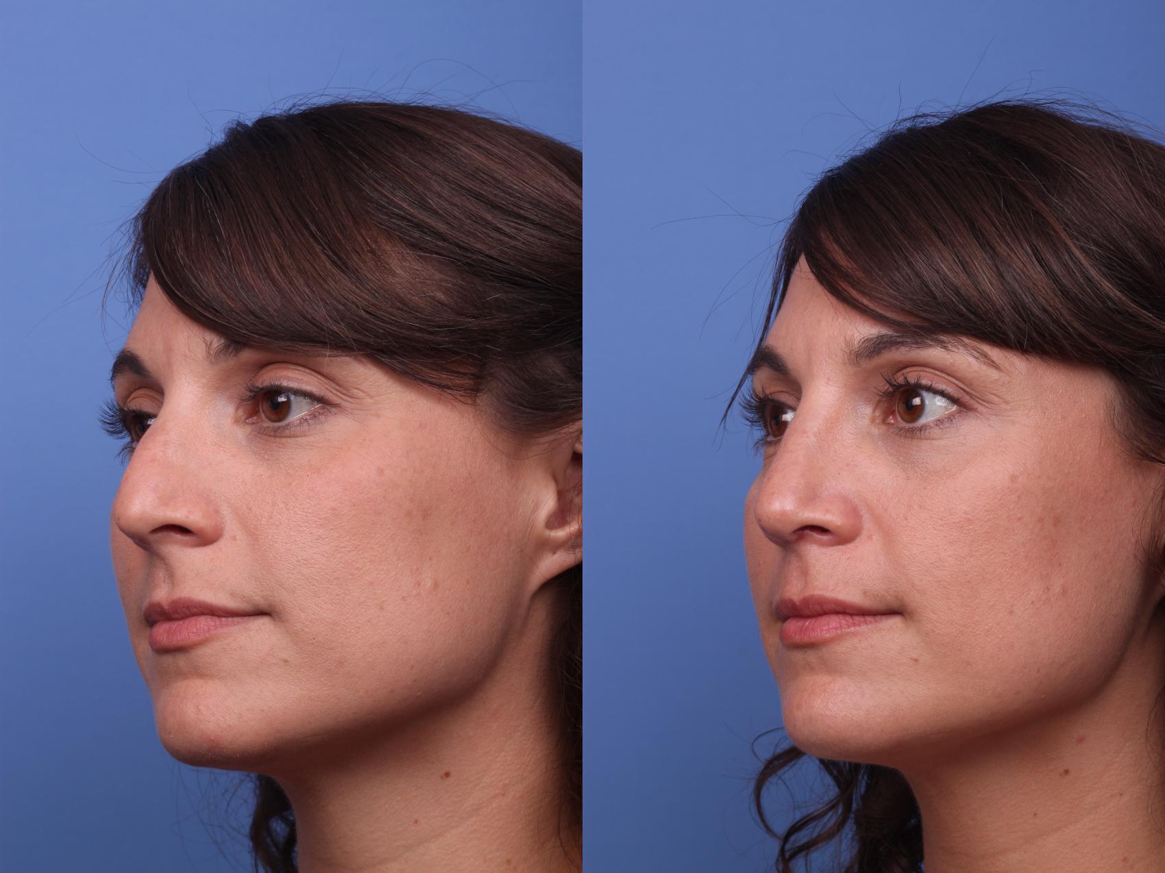 Before & After Rhinoplasty Case 243 View #3 View in Scottsdale, AZ