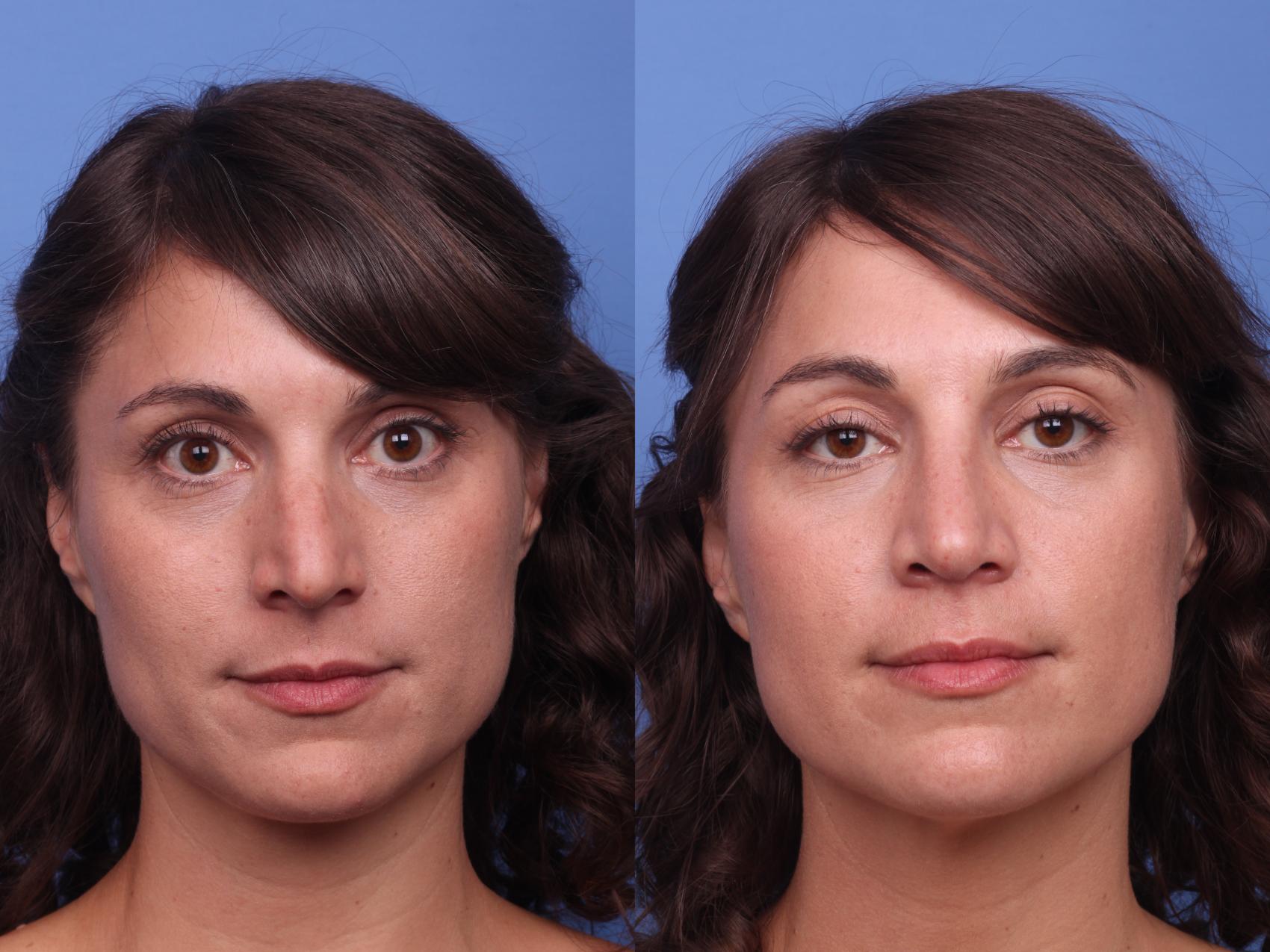 Before & After Rhinoplasty Case 243 View #4 View in Scottsdale, AZ