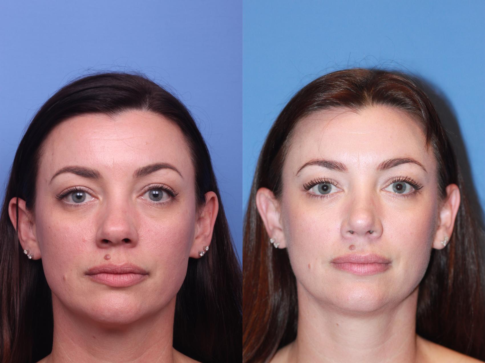 Before & After Rhinoplasty Case 246 View #1 View in Scottsdale, AZ