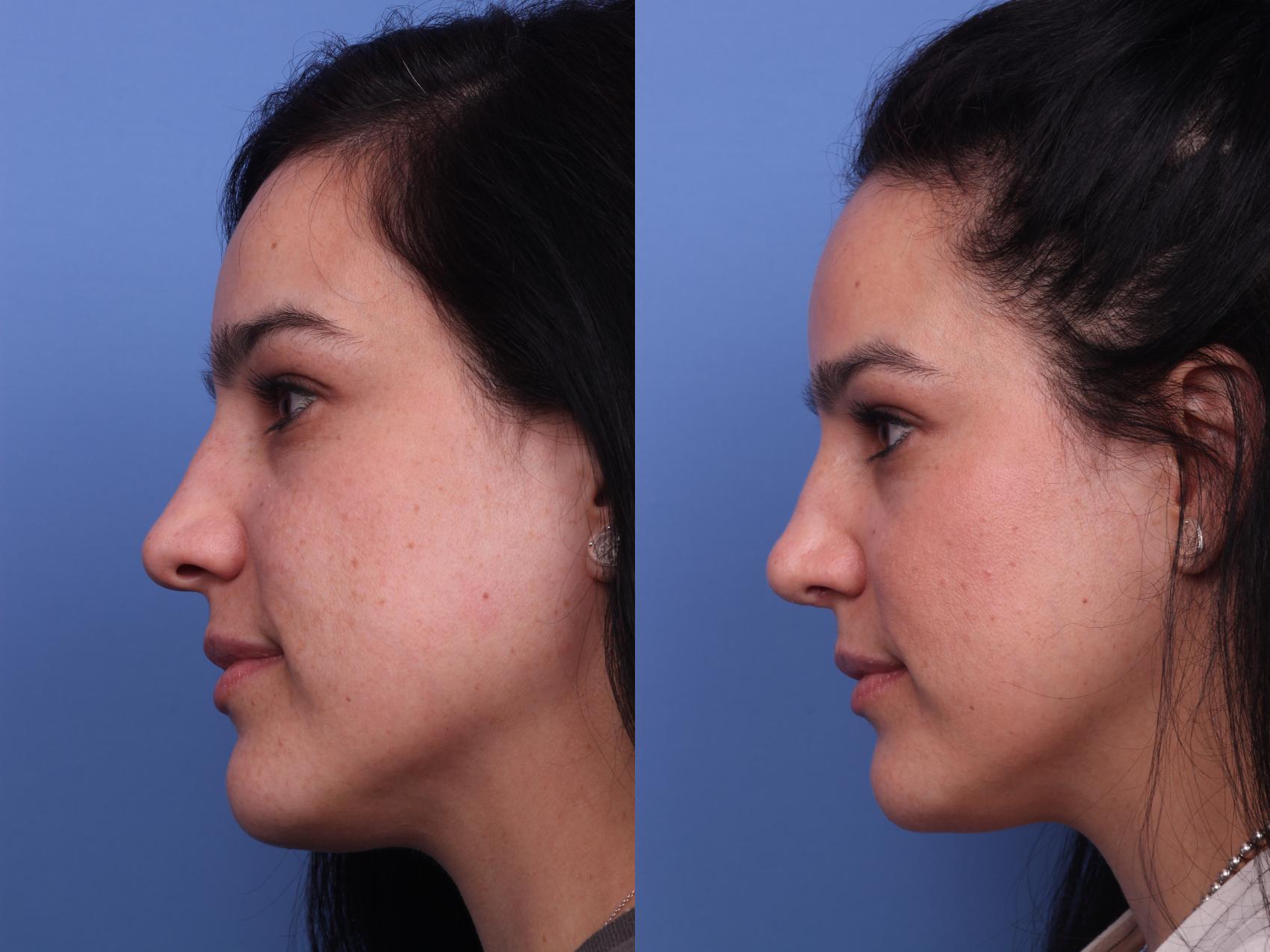 Before & After Rhinoplasty Case 248 View #2 View in Scottsdale, AZ