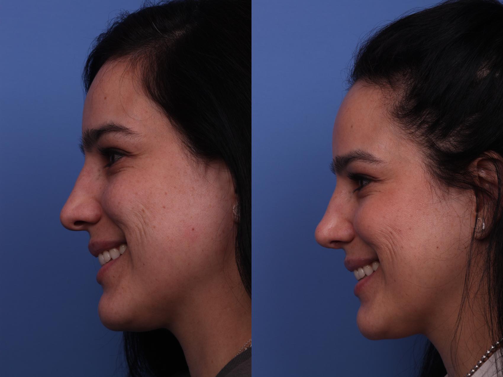 Before & After Rhinoplasty Case 248 View #3 View in Scottsdale, AZ