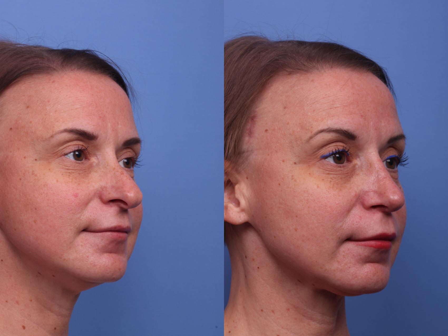 Before & After Rhinoplasty Case 249 View #2 View in Scottsdale, AZ