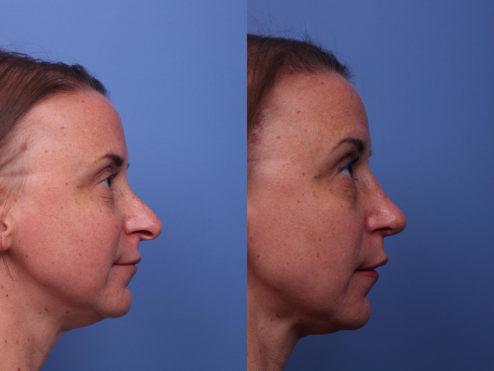 Before & After Rhinoplasty Case 249 View #3 View in Scottsdale, AZ