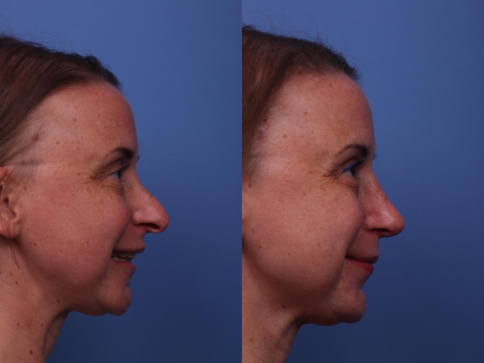 Before & After Rhinoplasty Case 249 View #4 View in Scottsdale, AZ
